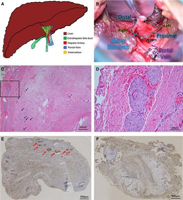 Role of cholinergic innervation in biliary remnants of patients with biliary atresia